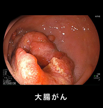 大腸がん