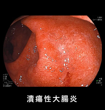 潰瘍性大腸炎