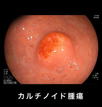 カルチノイド腫瘍