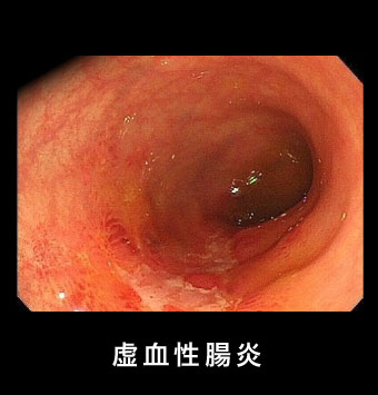 虚血性腸炎