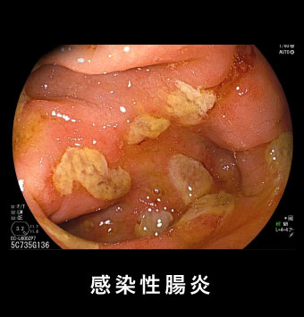 感染性腸炎